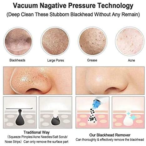 Blackhead Remover | أداة إزالة الرؤوس السوداء